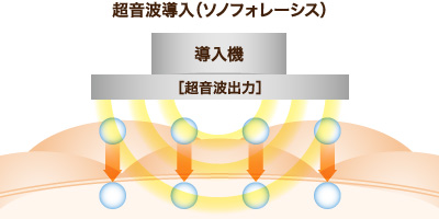 超音波導入(ソノフォレーシス)について